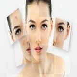 Get Rid of Acne (Guide)_playmods.net